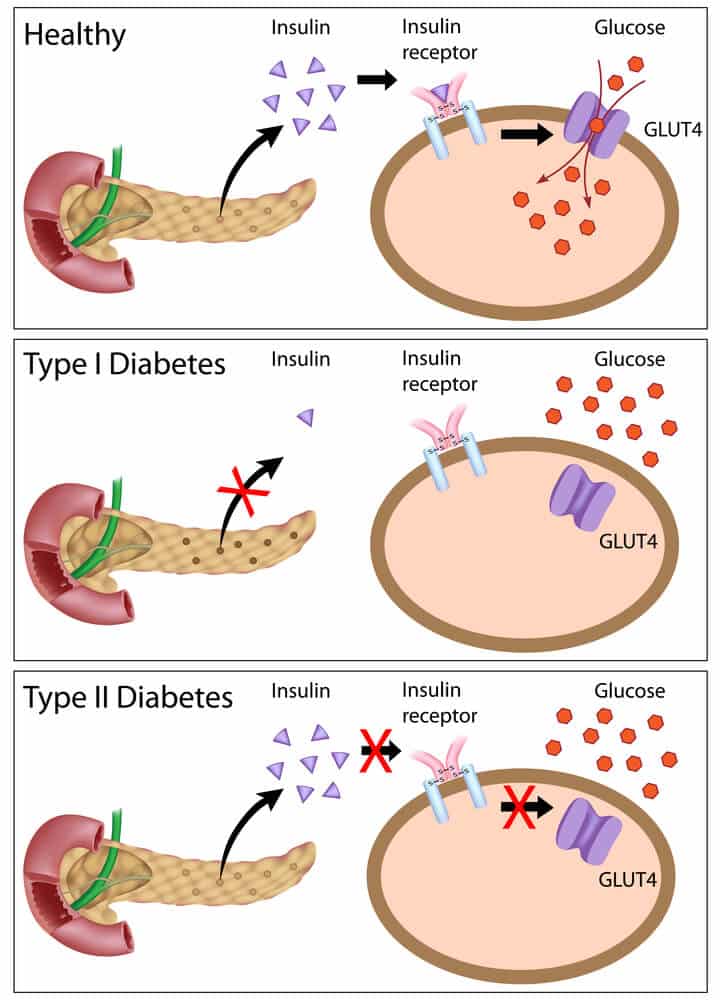 Differences between a healthy pancreatic cell and pancreatic cells affected by the autoimmune diseases type 1 and type 2 diabetes. Photo: shutterstock Differences between a healthy pancreatic cell and pancreatic cells affected by the autoimmune diseases type 1 and type 2 diabetes. Photo: shutterstock