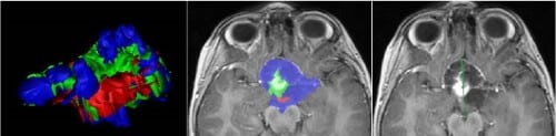 Quantitative assessment of a brain tumor, in a simple linear way (right) and as the product of the study (middle) that provides volumetric quantification of each of the components of the tumor, also in a three-dimensional view (left).