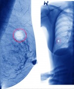 תצלום רטנגן של גידולי סרטן השד. צילום: shutterstock