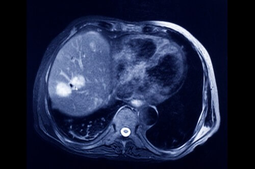 Detection of a tumor using an MRI scan. Photo: shutterstock