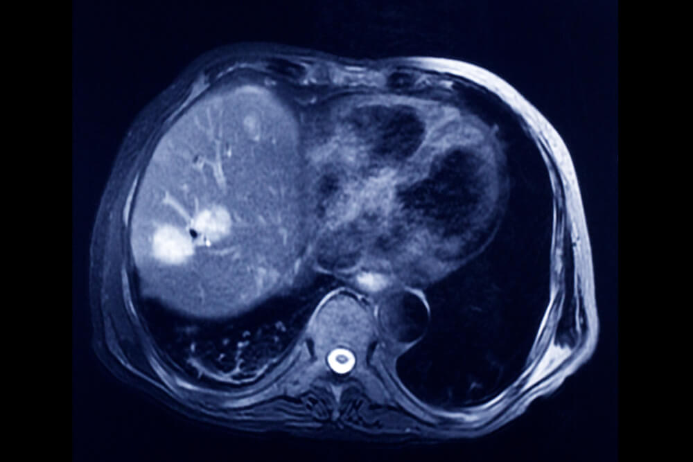 איתור של גידול בעזרת סריקת MRI. צילום: shutterstock