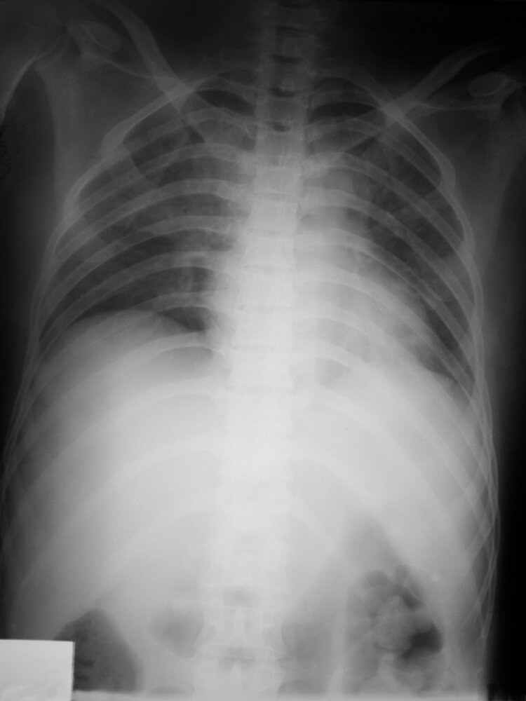 צילום רנטגן של חולה בדלקת ריאות. צילום: shutterstock