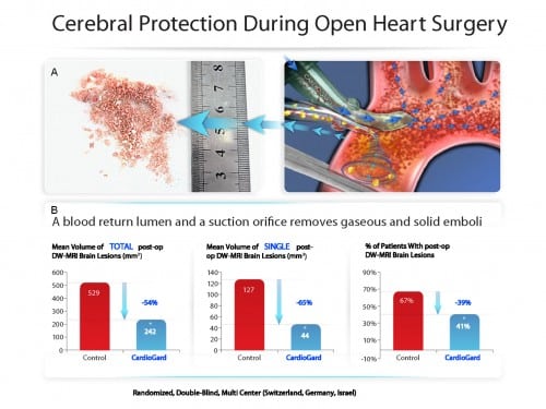 Picture 2 - A. Illustration of the blood vessels (right) and the fatty material collected in the tube developed by Cardiograd Co. (left). B. Graphs depicting the decrease in the number and volume of brain lesions in patients who underwent open heart surgery with the combination of Cardiograd Medical's tube. The quantitative measures were measured by Bioimage based on the MRI images.