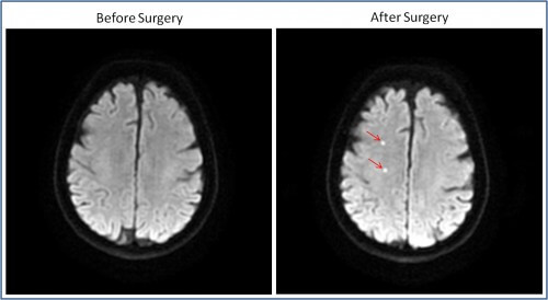 Picture 3 - on the right - a patient's brain before open heart surgery, on the left - a patient's brain after open heart surgery. The bright spots are the lesions caused by the blood clots that are released during open heart surgery.