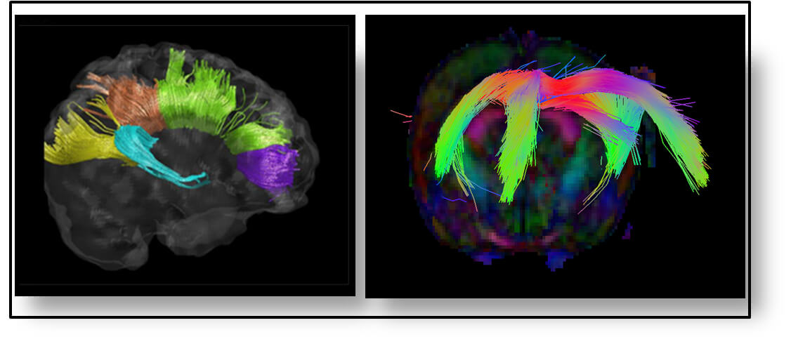 תמונה 4– שחזור מערכת סיבים ה- corpus callosum המקשרת בין הצד הימני לשמאלי של המוח. (משמאל – באדם, מימין – בחולדה).
