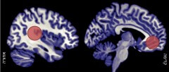 תמונה מס' 3: איזורי מוח חיוניים לחלימה: פגיעה באזורים המסומנים באדום מובילה להעדר מוחלט של חלימה (מכל סוג) למרות קיום שנת REM תקינה. אזורים אלו ידועים כחשובים לאינטגרציה חושית (הצומת בין האונה הטמפורלית (צדעית) לפריאטלית (קודקודית), צד שמאל), או לתפיסה של העצמי (החלק האמצעי התחתון של האונה הפרונטלית (מצחית), צד ימין).