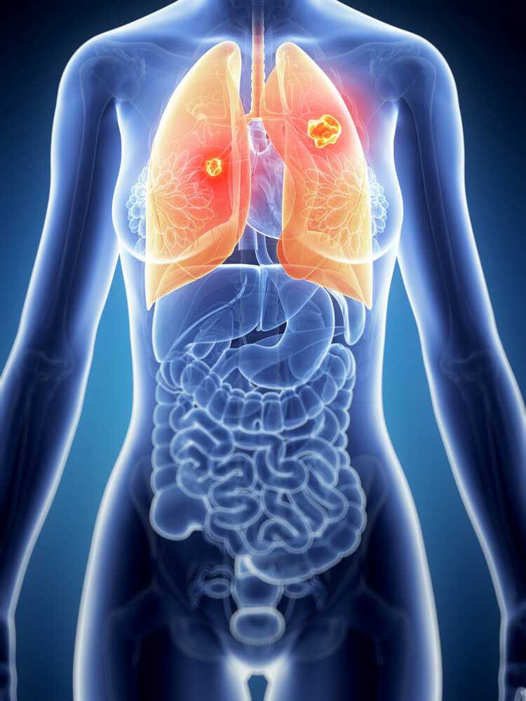 lung cancer. Image: Shutterstock