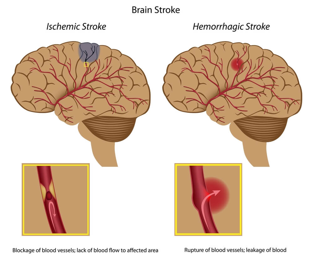 המחשת שני סוגי הפגיעות בכלי הדם הגורמות שבץ מוחי. איור: shutterstock