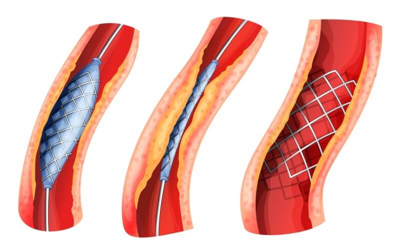 The process of widening a blocked artery with a stent. Photo: shutterstock