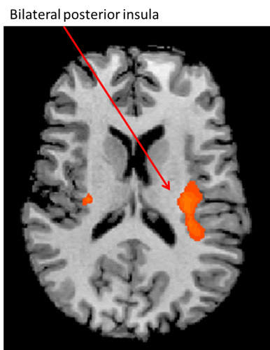 MRI scan of the insula.