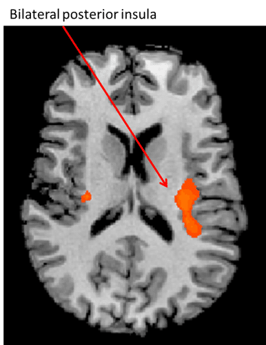 MRI scan of the insula.