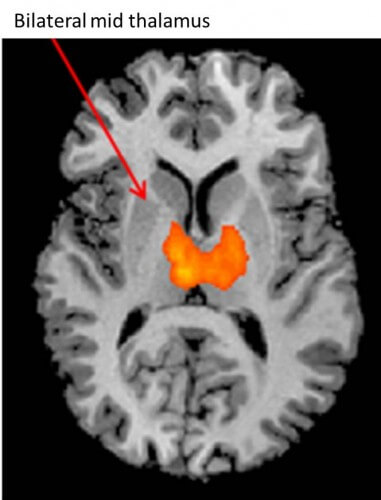 MRI photograph of the bilateral thalamus