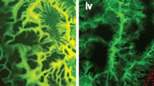 find the differences. The biological glue on a healthy (left) and cancerous (right) intestine. From: N. Oliva et al.,