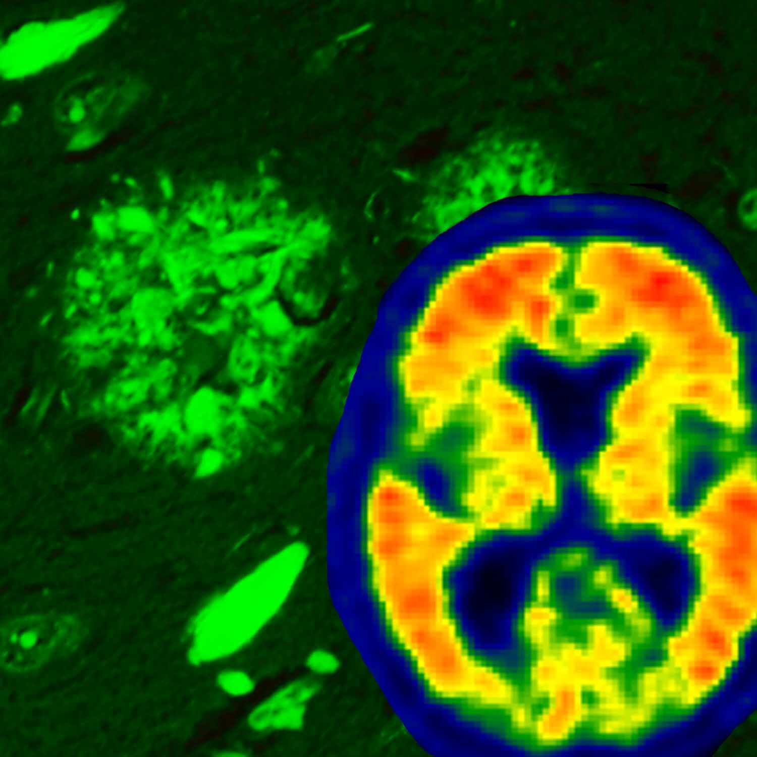 An amyloid scan, however, can give markers for TAU levels. Photo: Mayo Clinic