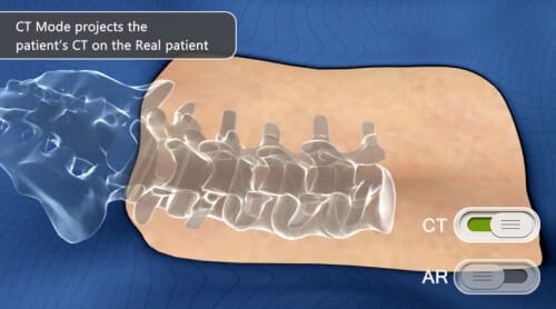 Imaging of spine surgery. Illustration: Augmedix