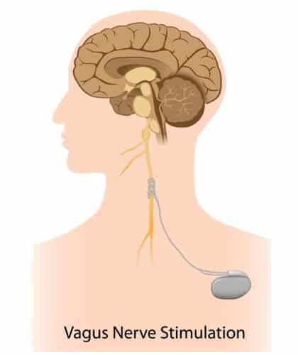 Stimulate the vagal nerve. Illustration: shutterstock