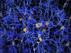 נוירונים עם גושי עמילואיד אצל חולי אלצהיימר. איור: shutterstock