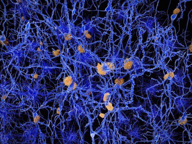 الخلايا العصبية التي تحتوي على كتل الأميلويد في مرضى الزهايمر. الرسم التوضيحي: شترستوك