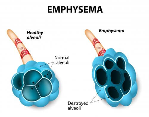 emphysema (emphysema). Illustration: shutterstock
