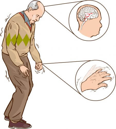 קשיש המתקשה בהליכה - אחד מתסמיני מחלת פרקינסון. איור: shutterstock