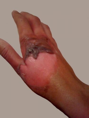 Burn from boiling water. From Wikipedia