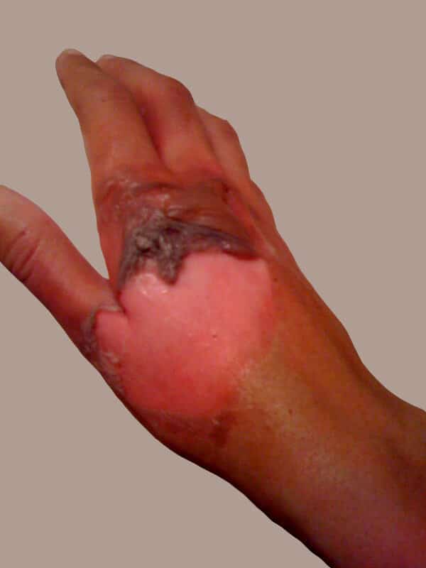 Burn from boiling water. From Wikipedia