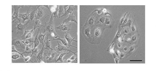 When the level of PYK2 is lowered through genetic engineering, metastatic breast cancer cells (left) revert to a non-invasive state (right). In this state they come into contact with each other and take the form of healthy tissue cells. Source: Weizmann Institute.