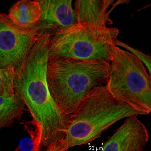 Thyroid cancer cells. Source: NASA / Team Daniela Grimm.