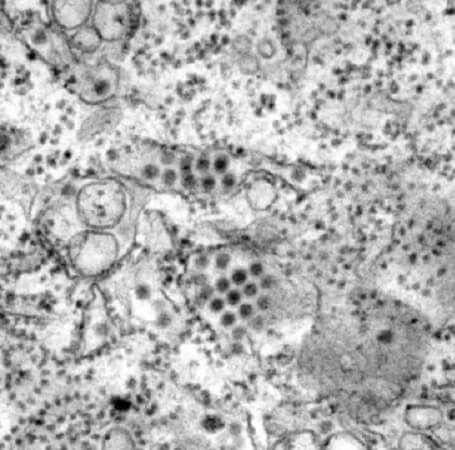 صورة مجهرية تظهر عدة جزيئات مستديرة من فيروس حمى الضنك في عينة الأنسجة. [بإذن من مركز السيطرة على الأمراض/فريدريك ميرفي]