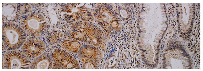 يشير اللون البني في المنطقة السرطانية (الجانب الأيسر من الصورة) إلى ارتفاع مستوى بروتين RNF4 - وهي ظاهرة غير موجودة في الأنسجة غير السرطانية في الجانب الأيمن. من دراسة أجراها البروفيسور أمير أورين من التخنيون.