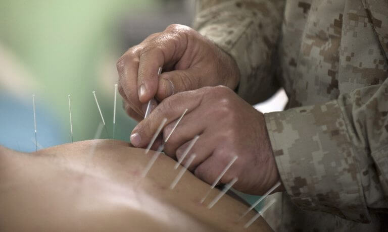 Acupuncture treatment. Source: US Navy.