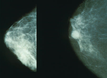 צילום רנטגן של שד בריא (שמאל) לעומת שד עם סרטן. מקור: ויקימדיה.