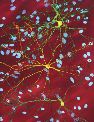 נוירונים פגומים במוח של חולה הנטינגטון. מקור: Dr. Steven Finkbeiner, Gladstone Institute of Neurological Disease / Wikimedia.