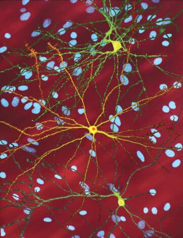 Damaged neurons in the brain of a Huntington's patient. Source: Dr. Steven Finkbeiner, Gladstone Institute of Neurological Disease / Wikimedia.