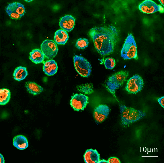 Cross-sectional image from a confocal microscope: breast cancer cells with high metastatic potential push into a polyacrylamide gel with a stiffness of 2.4 kPa, where this section is at a depth of 10.6 microns below the surface of the gel. In the picture you can see the cell nuclei (red), the actin element in the intracellular skeleton (green) and the connections of the cells to the surface at connection centers (blue).