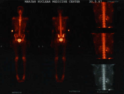 Inside information: Scans to diagnose bone cancer rely on a rare isotope called technetium 99m. Photo: Zereshk.