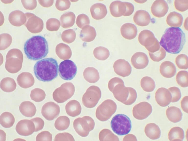 leukemic cells. Evolve from "cancer stem cells". Photo: Mary Ann Thompson / Wikimedia.