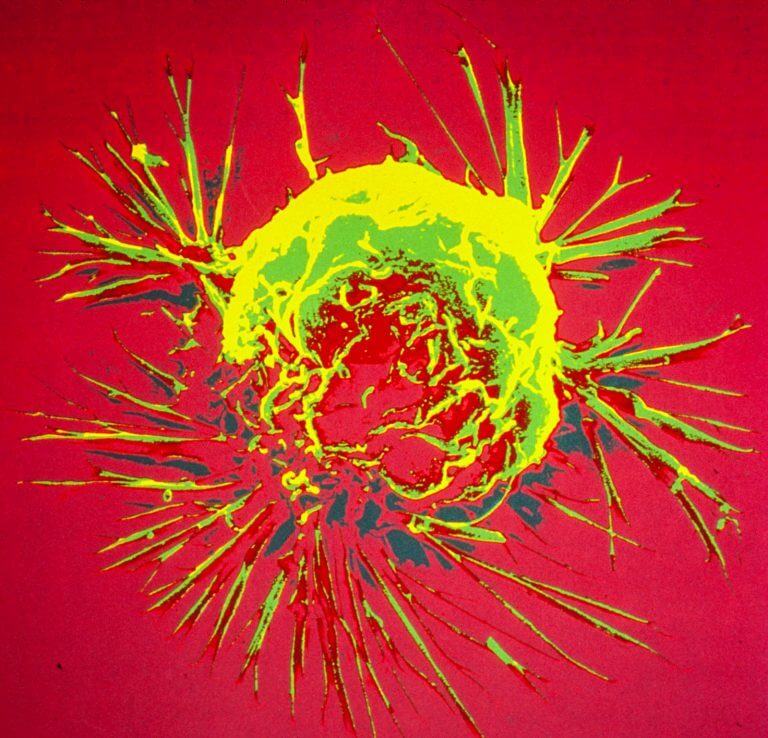 צילום מיקרוסקופ אלקטרונים של תא שד סרטני. מקור: Bruce Wetzel and Harry Schaefer, National Cancer Institute, National Institutes of Health.