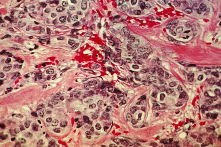 תאי שד סרטניים (בכחול). מקור: NIH.
