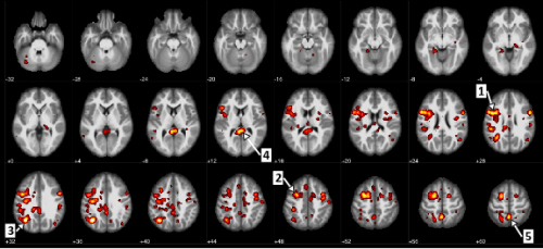 Brain regions showing statistically significant changes between schizophrenia patients and healthy subjects. So, for example, arrow 1 points to an area in the motor cortex, and arrow 5 points to the precuneus, which is involved in processing visual information. Source: IBM.