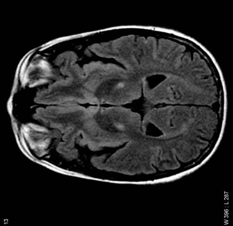 MRI scan of an ALS patient. Source: Frank Gaillard, Wikimedia.