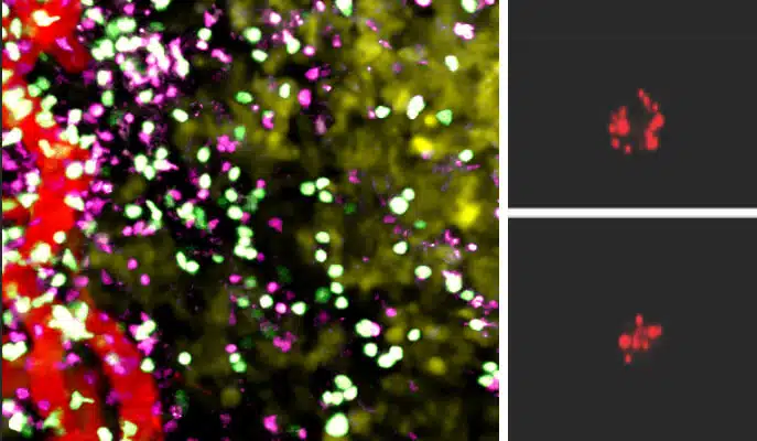 משמאל: גידול סרטני תחת מיקרוסקופ: חדירת תאי T רגילים (סגול) לרקמת הגידול אינה שונה מזו של תאי T אשר גודלו בתנאי מחסור בחמצן (ירוק). מימין: כמות האנזים "גרנזיים B" (אדום), אשר הורג תאי סרטן, גדולה בהרבה בתאי T אשר גודלו בסביבה דלת חמצן (למעלה) לעומת תאי T רגילים (למטה). מקור: מגזין מכון ויצמן.
