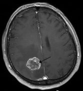 גרורה סרטנית במוח, שמקורה בסרטן ריאה. צילום: Marvin 101, Wikimedia.