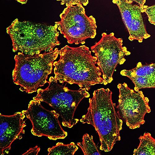 תאי מלנומה גרורתיים. תמונת אילוסטרציה. מקור: National Cancer Institute.