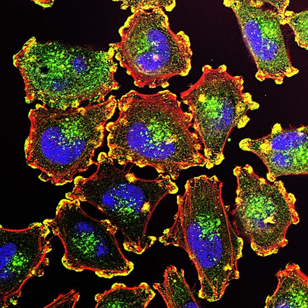 Metastatic melanoma cells. Illustration image. Source: National Cancer Institute.