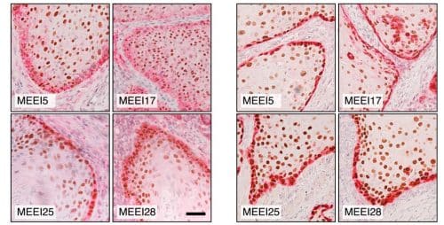 Immunohistochemical photographs of samples from head and neck cancer tumors in two patients. Colored in brown and red are early markers for the transformation of the cells in the outer margins into cells of a different type in preparation for migration in the body and the formation of metastases. Source: Weizmann Institute magazine.