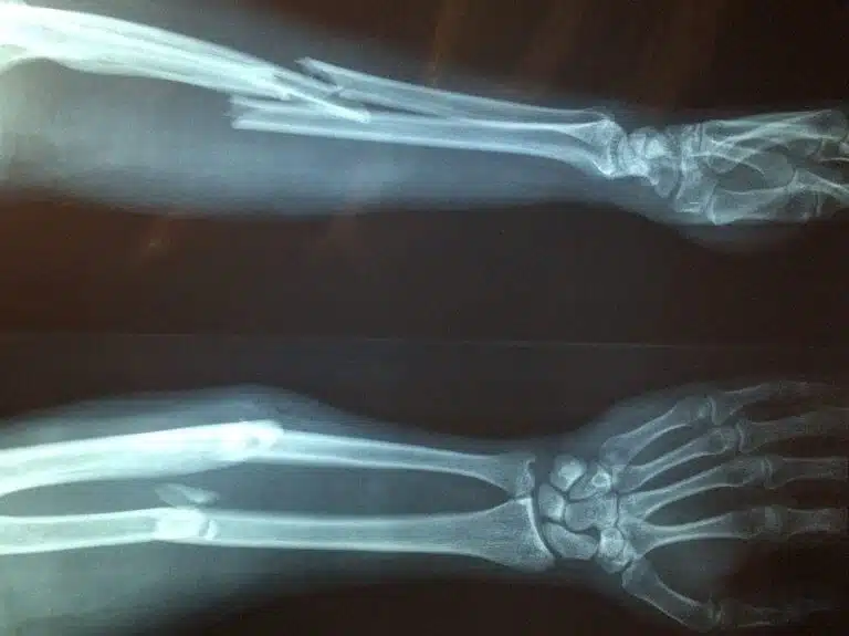 אוסטאופורוזיס הוא הגורם הנפוץ ביותר לעצמות שבורות אצל קשישים משני המינים. אילוסטרציה: pixabay.