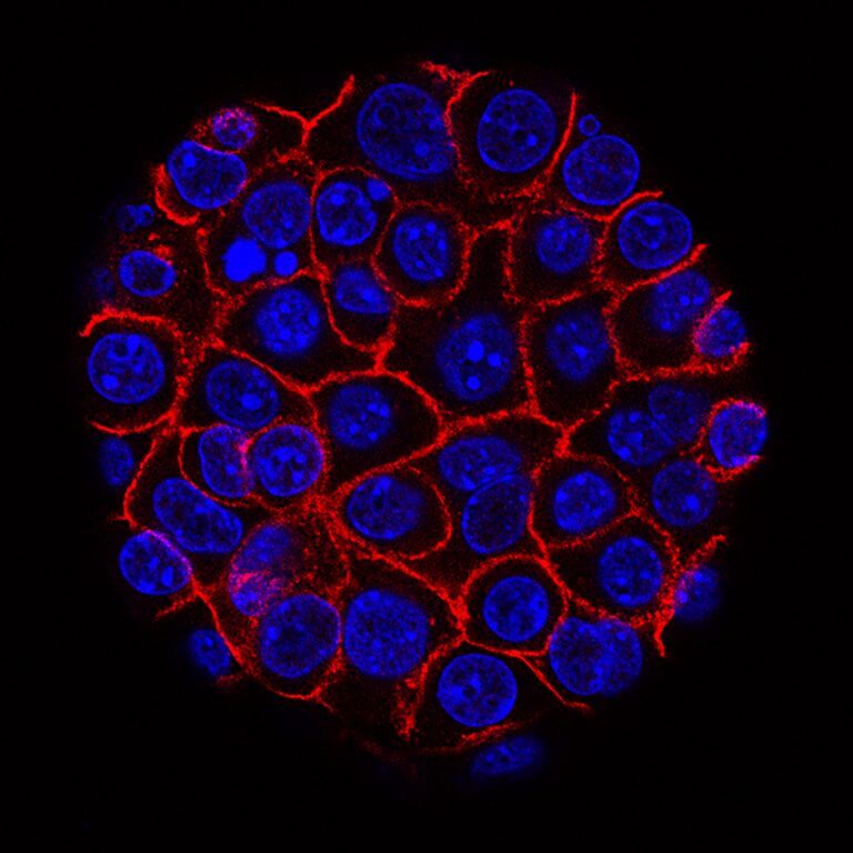 Cancer cells. Illustration: NIH (Yu (Eli and Edythe Broad Center for Regenerative Medicine and Stem Cell Research at USC), USC Norris Comprehensive Cancer Center, Pancreatic Desmoplasia).