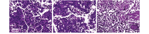 EVOC cultures from a breast cancer tumor - without treatment (left) and after adding two chemotherapy drugs (right). In the two pictures on the left, the tumor keeps its shape, on the right - the drug destroys the tumor. Source: Weizmann Institute magazine.