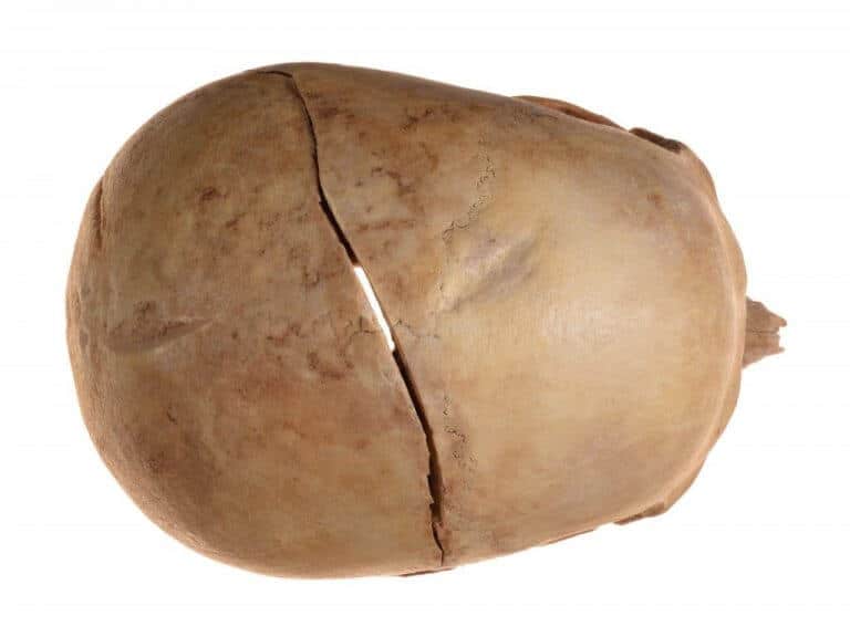 الكسور في قبة الجمجمة. تصوير: كلارا عميت، هيئة الآثار